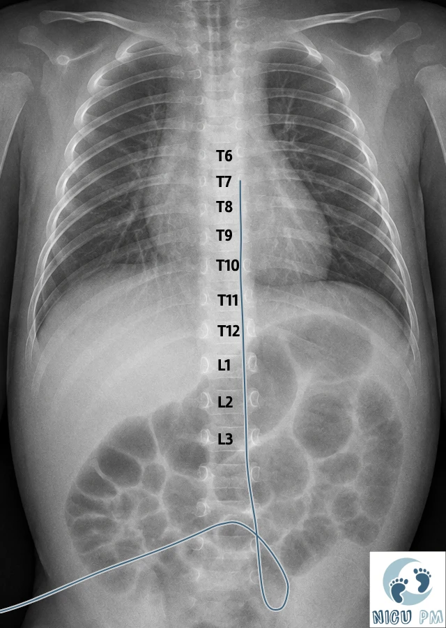 Neonatal line position reference